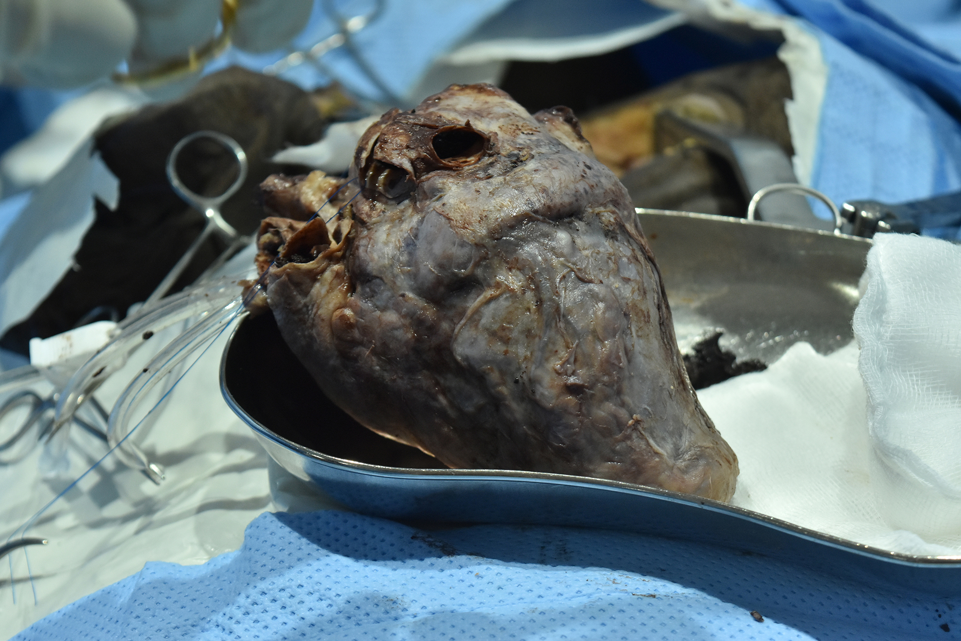 Multi-Organ Retrieval & Transplantation - 4